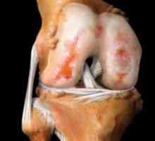 Liečba kolenných kĺbov z gonartrózy