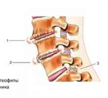 Liečba chrbtice na chrbtici a príznaky osteofytov