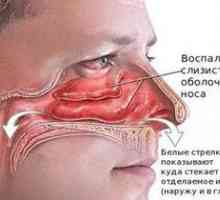 Liečba zápalu nosovej sliznice