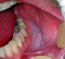 Liečba chorôb ústnej sliznice