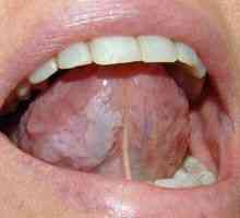 Leukoplakia ústnej sliznice: liečba