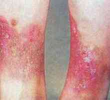 Lipodermatoskleróza alebo varikózna dermatitída: príznaky