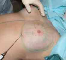 Lipofilling prsných žliaz: črty operácie