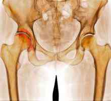 Metódy liečby artrózy kĺbového kĺbu o 1, 2 a 3 stupňoch