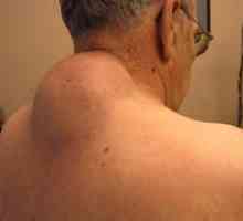 Spôsoby liečenia wenu na chrbte a fotografie lipómu