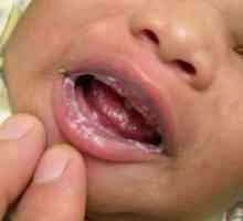 Draslík v ústach v liečbe dieťaťa