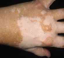 Počiatočná fáza vitiligu u detí