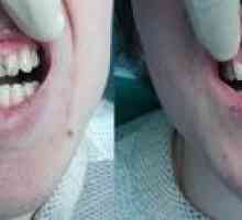 Zubná stavba: koľko je a akú metódu si vybrať