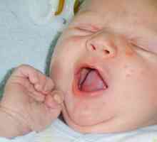 Aké nebezpečné sú akné na tvári novorodenca?