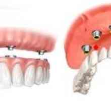 Fixované zubné protézy: typy, cena