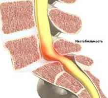 Nestabilita krčnej chrbtice: liečba a symptómy