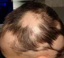 Alopecia areata (plešatosť): prejavy ochorenia a liečba