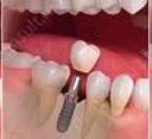 Okamžitá implantácia zubov: ceny a opis metódy