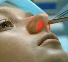 Cauterizácia ciev v nose: priebeh a dôsledky