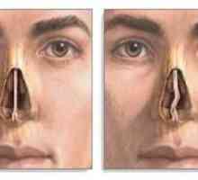 Operácia na zakrivenie nosnej septa a diagnostika odchýlky