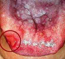 Popis a liečba červených plochých lišajníkov v ústnej dutine