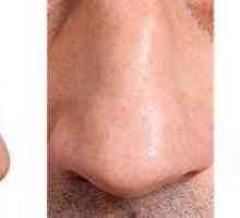 Eaglovým nosom u žien a mužov: rysy a nevýhody