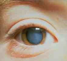 Komplikovaná katarakta oboch očí: čo je táto patológia?