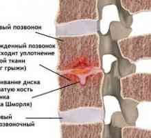 Vlastnosti hernie shmorlya a princípy liečby chrbtice