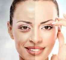 Vlastnosti chemického želé peelingu chemické ošetrenie tváre