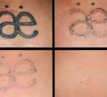 Vlastnosti odstránenia laserového tetovania