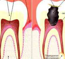 Akútna parodontitída: príčiny, symptómy a liečba