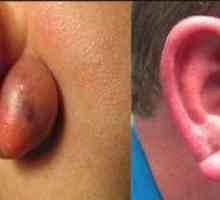 Čo robí hrudku na laloku ucha?