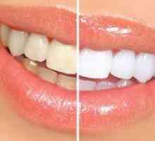 Bielenie zubov úžasné biele: vlastnosti postupu