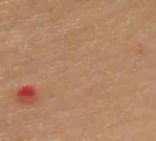 Prečo sa na tele objavujú malé červené bodky?