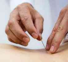 Recenzia na akupunktúru s kýlou v bedrovej chrbtici