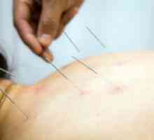 Recenzie o akupunktúre pre osteochondrózu krčnej chlopne