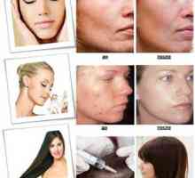 Ozónová terapia tváre v kozmeteológii