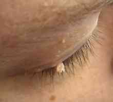 Papilómy na tvári: funkcie liečby a fotografie