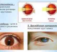 Patológia nízkeho videnia u detí: astigmatizmus, čo to je?