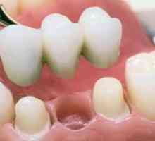 Plastové korunky na predných zuboch