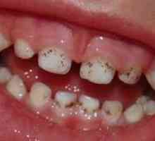 Prečo sa na zuboch objavujú čierne škvrny a ako sa môžu liečiť?