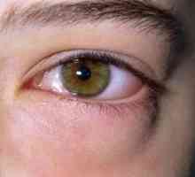 Vedľa oka sa objavil nepríjemný opuch: príčiny
