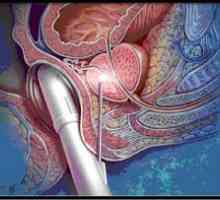 Príprava na biopsiu prostaty