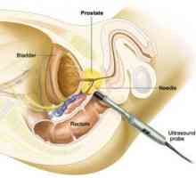 Príprava na hypertyroidizmus prostaty a ako analyzovať