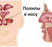 Polypóza nosa: príznaky a liečba