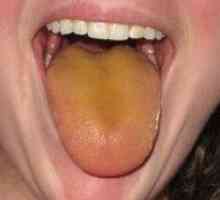 Na aké ochorenia sa na jazyku nachádza žltkastá farba