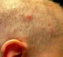 Príčiny a liečba akné na hlave vo vlasoch mužov