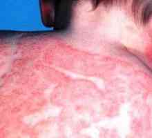 Príčiny, symptómy a liečba atopickej dermatitídy