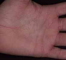 Príčiny svrbenia dlane - prečo sú moje ruky svrbiace?