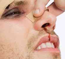 Známky zlomeniny nosovej kosti u postihnutej osoby