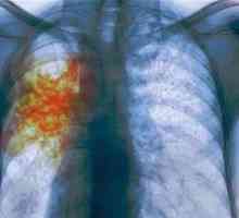 Známky tuberkulózy v počiatočných štádiách dospelých
