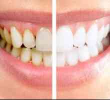 Profesionálne čistenie zubov v zubnom lekárstve: typy a popis