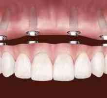 Protézy zubov na implantátoch: odnímateľná protéza