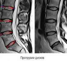 Protrúzia chrbtice bedrovej chrbtice: znaky a príznaky