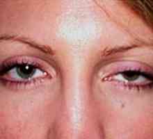 Ptóza horného očného viečka: príčiny a liečba patológie